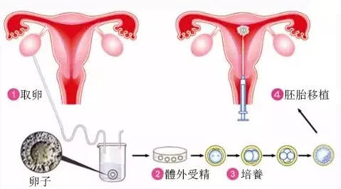供卵试管婴儿前应做哪些检查？供卵试管婴儿过程