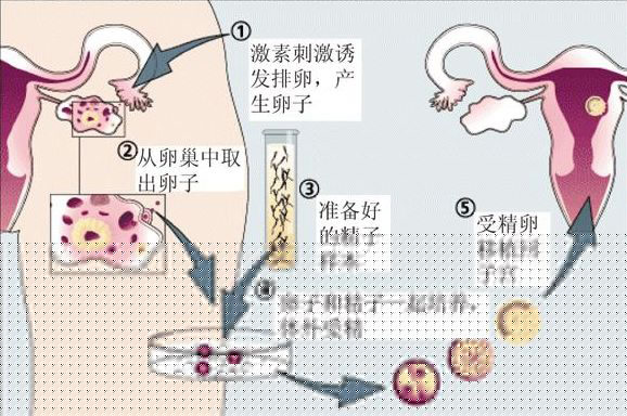 正常的夫妻可以做试管婴儿