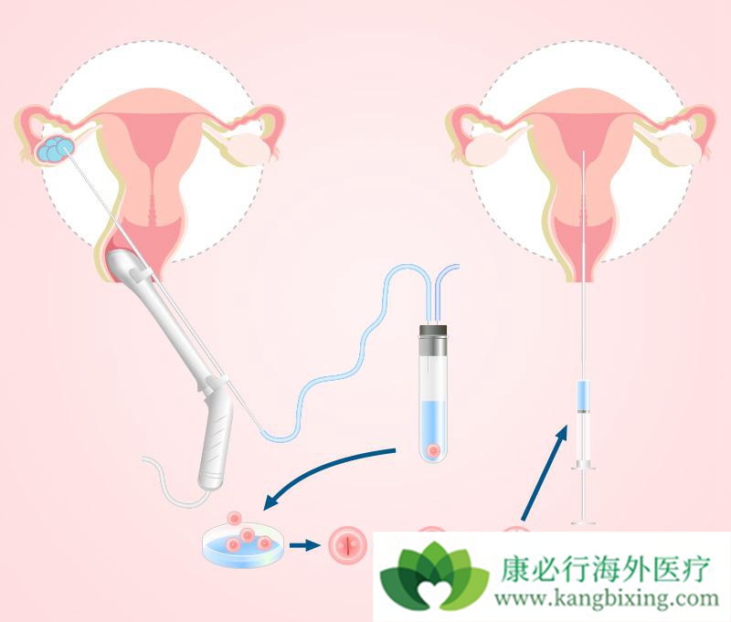 卵巢囊腺瘤的血供_囊腺瘤严重吗